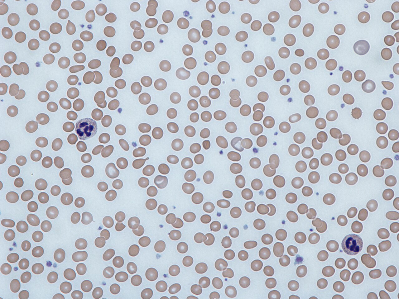 Anemia Symptoms: What Your Blood Test Reveals About Your Iron